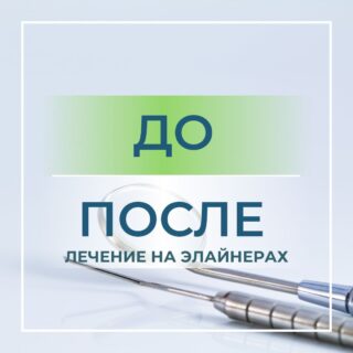 Элайнеры представляют собой прозрачные каппы, которые поэтапно исправляют прикус пациента. ⠀ В отличие от брекетов, элайнеры почти незаметны на зубах.? ⠀ Перед тем как приступить к лечению, врач соберет все нужные данные ?о прикусе пациента. ⠀ Помимо осмотра?, сделает снимки, слепки и гипсовые модели, разнообразные фотографии лица пациента в разных ракурсах, с улыбкой и без. Это необходимо для расчетов, моделирования перемещения зубов и дальнейшего наблюдения за прогрессом в период лечения?. ⠀ После этого составляется план лечения, а все собранные материалы передаются в компанию производящую каппы.? ⠀ На весь период лечения пациента, в среднем, уходит 30 пар кап. Большая их часть отливается сразу и некоторые выдаются на руки?? пациенту, для самостоятельной замены. ⠀ Курс лечения в среднем составляет около 1,5 лет. В зависимости от сложности патологии прикуса этот срок может увеличиваться или уменьшаться. ⠀ Элайнеры проложат путь к вашей эстетичной улыбке?. ⠀ Для записи к нам в клинику звоните по телефону +7-977-900-43-17, пишите в "директ" ?.
